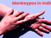 Monkeypox